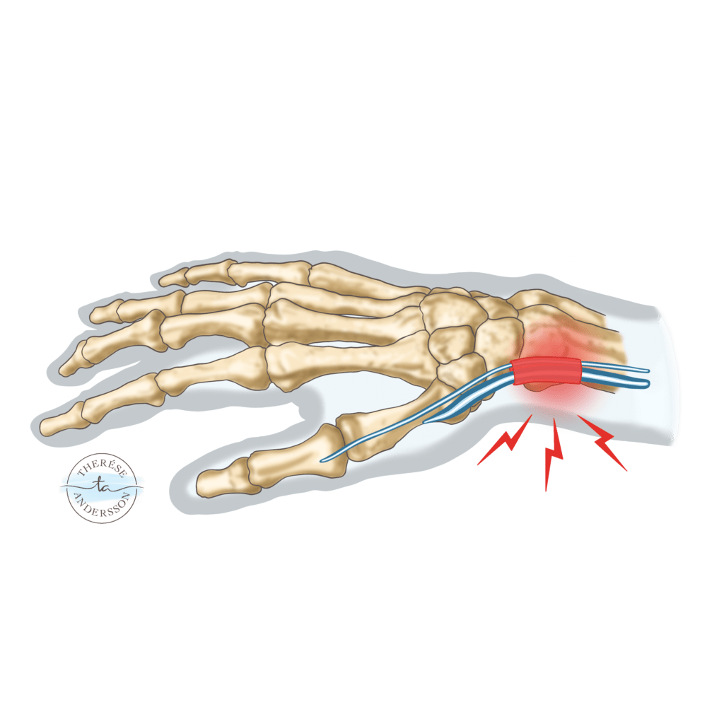 Morbus De Quervain Handcenter Morbus De Quervain Handcenter